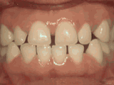 Gaps in teeth closed