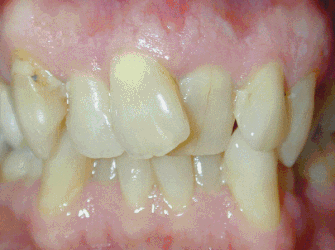 Animation showing tooth closure